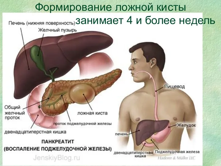 Формирование ложной кисты занимает 4 и более недель