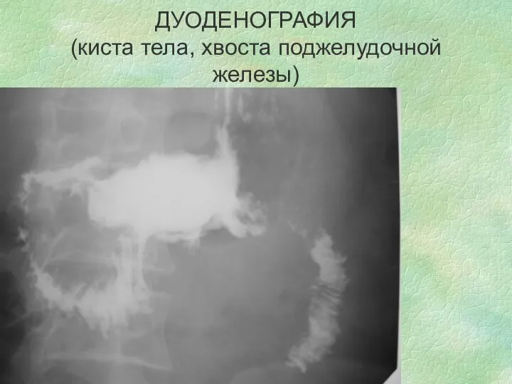 ДУОДЕНОГРАФИЯ (киста тела, хвоста поджелудочной железы)