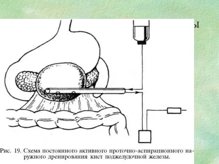 Наружное дренирование кисты