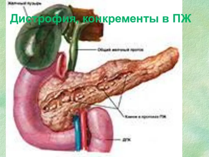 Дистрофия, конкременты в ПЖ