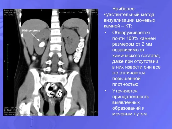 Наиболее чувствительный метод визуализации мочевых камней – КТ: Обнаруживается почти 100%