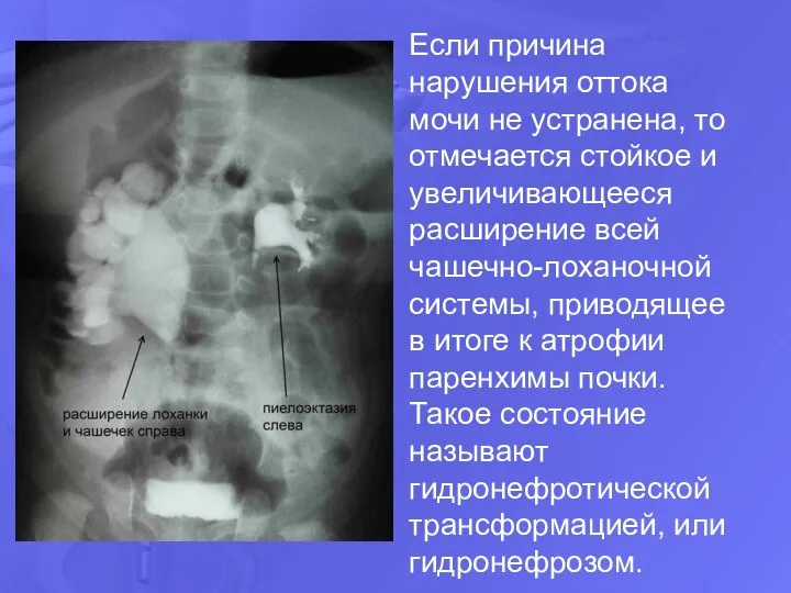 Если причина нарушения оттока мочи не устранена, то отмечается стойкое и