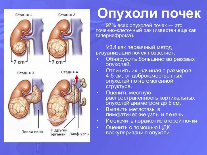 Опухоли почек 97% всех опухолей почек ― это почечно-клеточный рак (известен