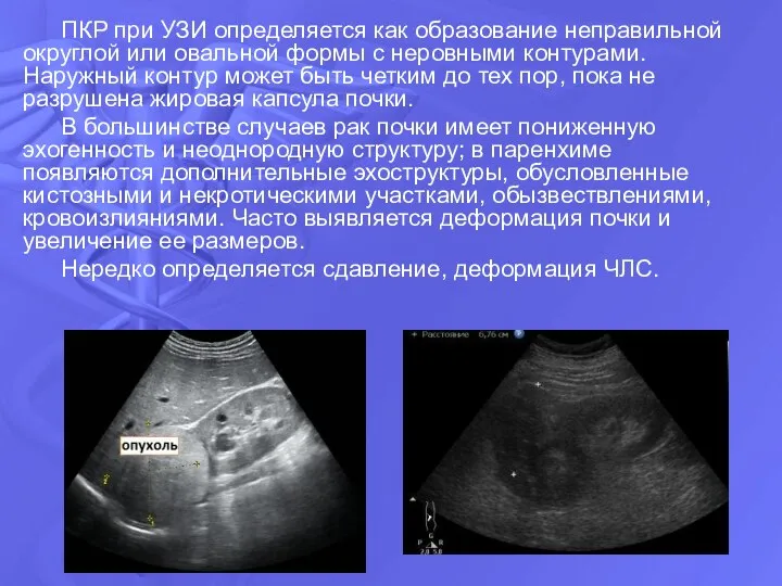 ПКР при УЗИ определяется как образование неправильной округлой или овальной формы