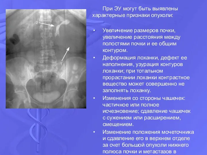 При ЭУ могут быть выявлены характерные признаки опухоли: Увеличение размеров почки,