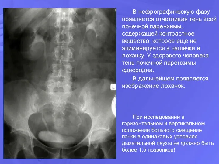 В нефрографическую фазу появляется отчетливая тень всей почечной паренхимы, содержащей контрастное
