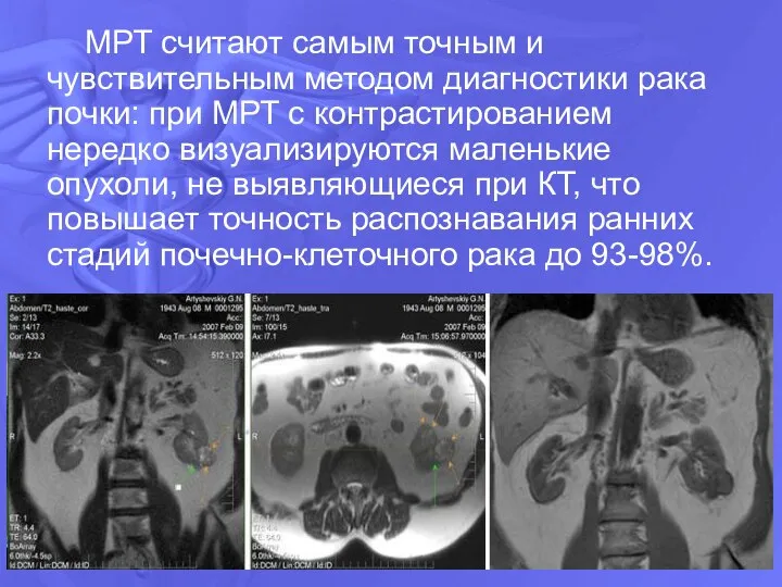 МРТ считают самым точным и чувствительным методом диагностики рака почки: при