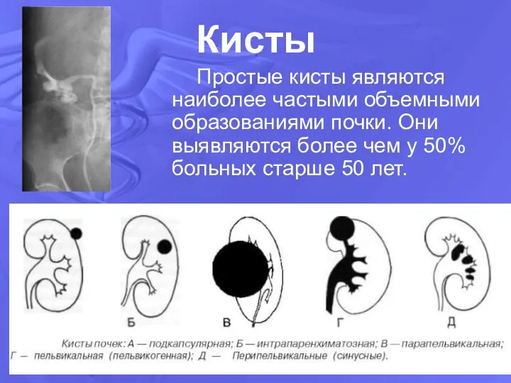 Кисты Простые кисты являются наиболее частыми объемными образованиями почки. Они выявляются