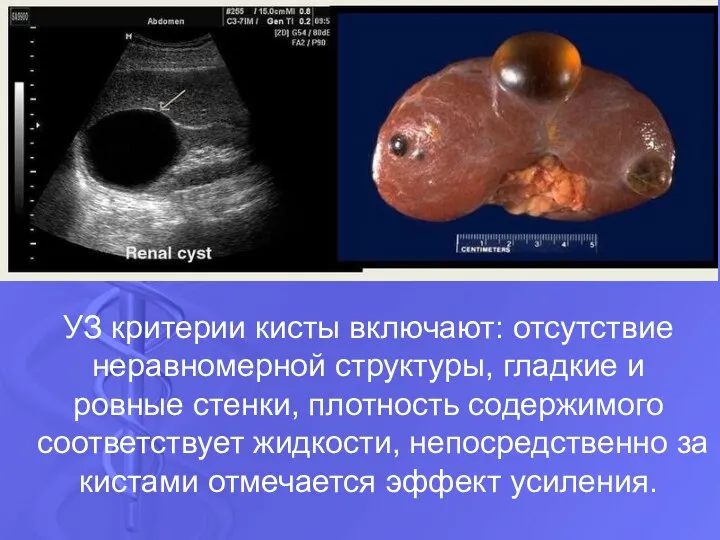 УЗ критерии кисты включают: отсутствие неравномерной структуры, гладкие и ровные стенки,