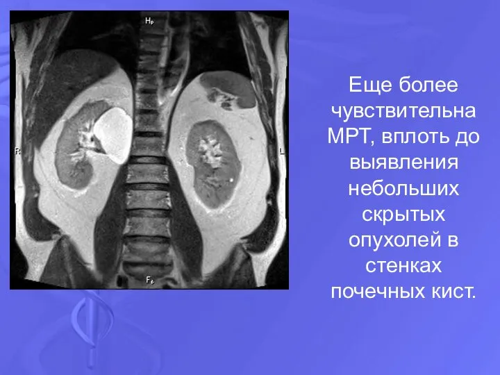 Еще более чувствительна МРТ, вплоть до выявления небольших скрытых опухолей в стенках почечных кист.