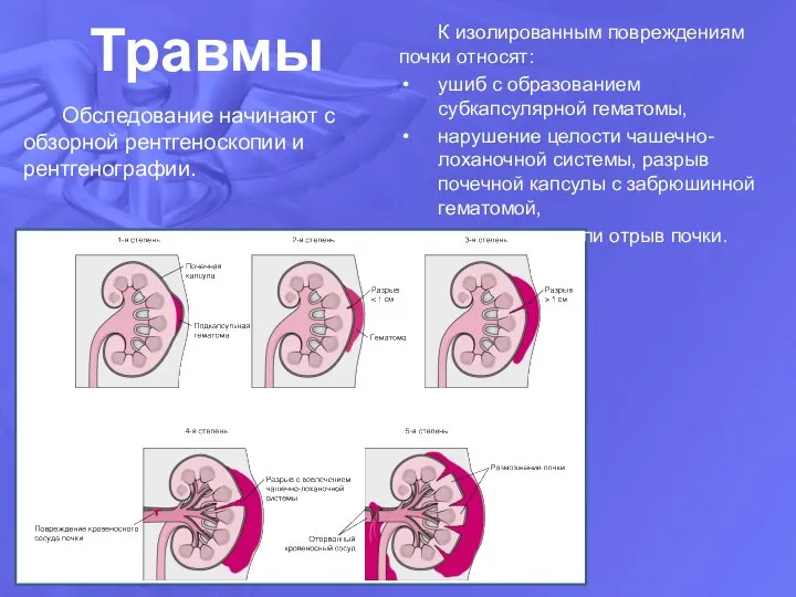 Травмы К изолированным повреждениям почки относят: ушиб с образованием субкапсулярной гематомы,