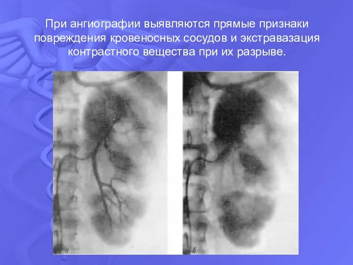 При ангиографии выявляются прямые признаки повреждения кровеносных сосудов и экстравазация контрастного вещества при их разрыве.