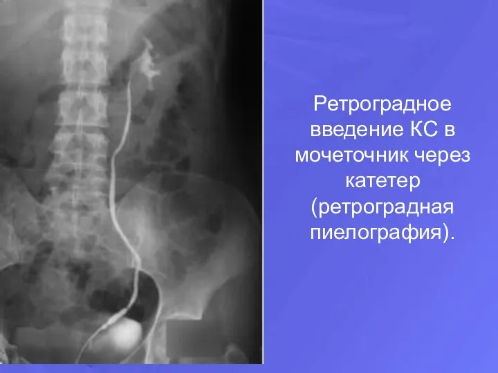 Ретроградное введение КС в мочеточник через катетер (ретроградная пиелография).