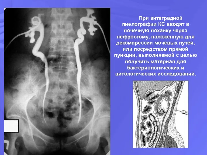 При антеградной пиелографии КС вводят в почечную лоханку через нефростому, наложенную