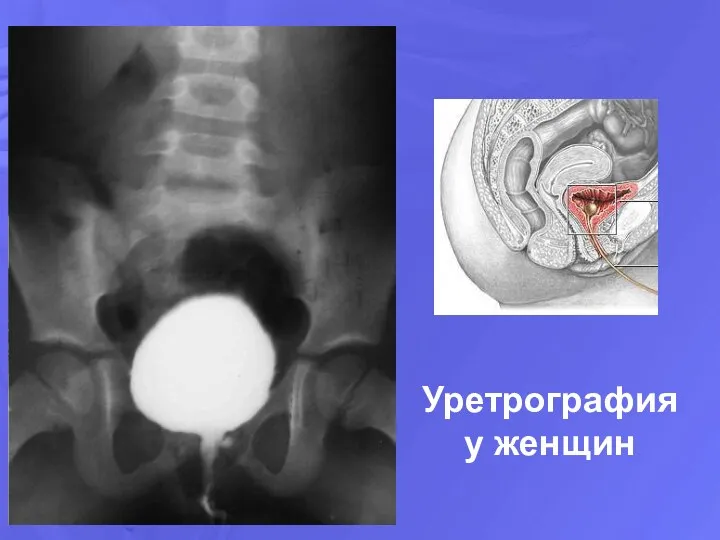 Уретрография у женщин