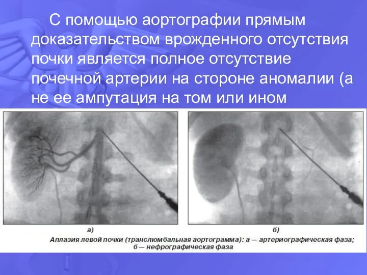 С помощью аортографии прямым доказательством врожденного отсутствия почки является полное отсутствие