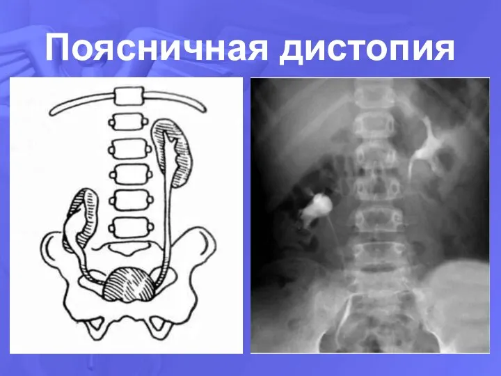 Поясничная дистопия