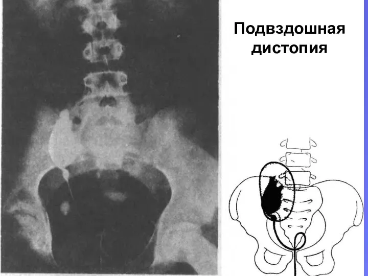 Подвздошная дистопия