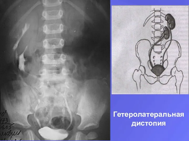 Гетеролатеральная дистопия