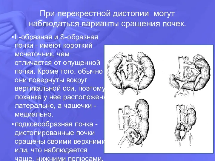 При перекрестной дистопии могут наблюдаться варианты сращения почек. L-oбразная и S-oбразная