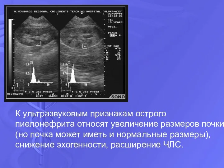 К ультразвуковым признакам острого пиелонефрита относят увеличение размеров почки (но почка