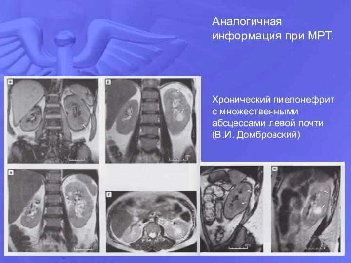 Аналогичная информация при МРТ. Хронический пиелонефрит с множественными абсцессами левой почти (В.И. Домбровский)