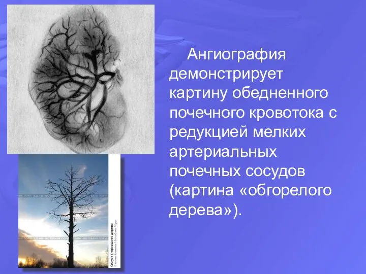 Ангиография демонстрирует картину обедненного почечного кровотока с редукцией мелких артериальных почечных сосудов (картина «обгорелого дерева»).