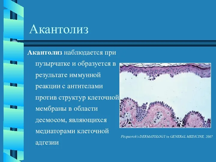 Акантолиз Акантолиз наблюдается при пузырчатке и образуется в результате иммунной реакции