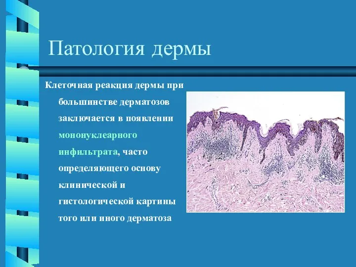 Патология дермы Клеточная реакция дермы при большинстве дерматозов заключается в появлении