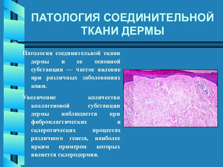 Патология соединительной ткани дермы и ее основной субстанции — частое явление
