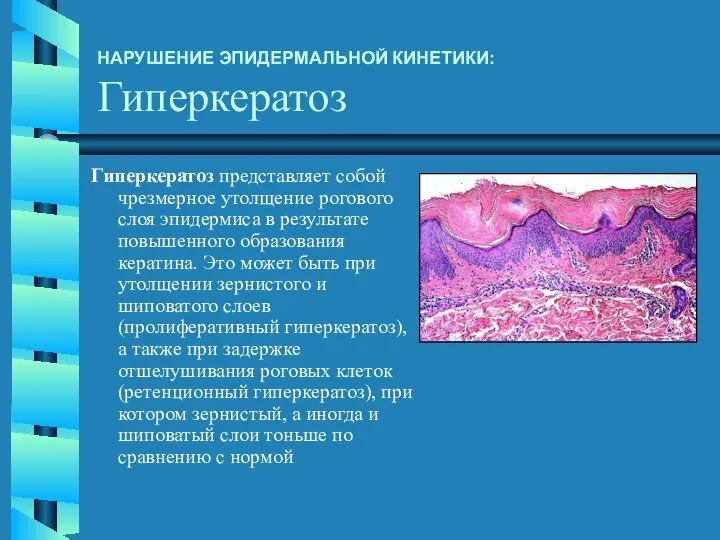 Гиперкератоз представляет собой чрезмерное утолщение рогового слоя эпидермиса в результате повышенного