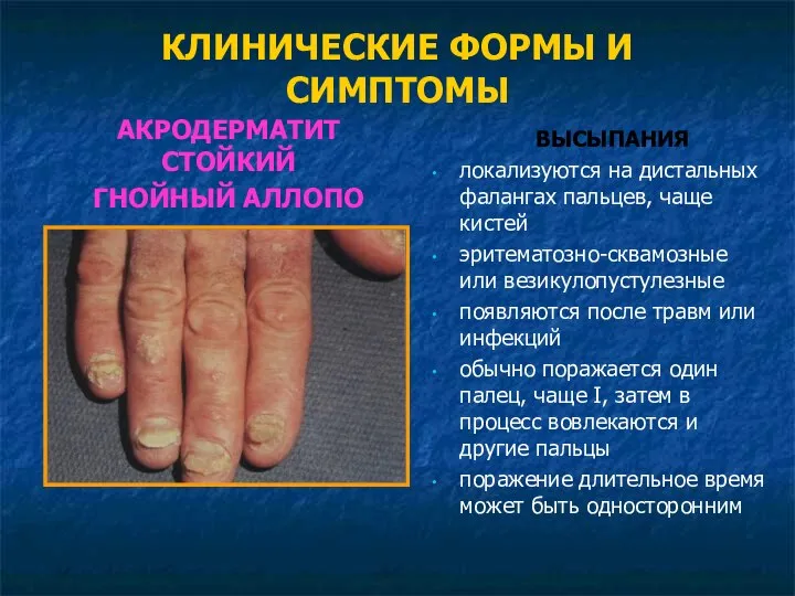 КЛИНИЧЕСКИЕ ФОРМЫ И СИМПТОМЫ ВЫСЫПАНИЯ локализуются на дистальных фалангах пальцев, чаще