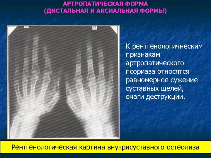 Рентгенологическая картина внутрисуставного остеолиза АРТРОПАТИЧЕСКАЯ ФОРМА (ДИСТАЛЬНАЯ И АКСИАЛЬНАЯ ФОРМЫ) К