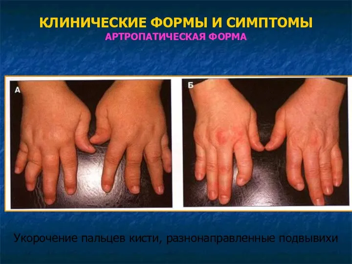 КЛИНИЧЕСКИЕ ФОРМЫ И СИМПТОМЫ АРТРОПАТИЧЕСКАЯ ФОРМА Укорочение пальцев кисти, разнонаправленные подвывихи