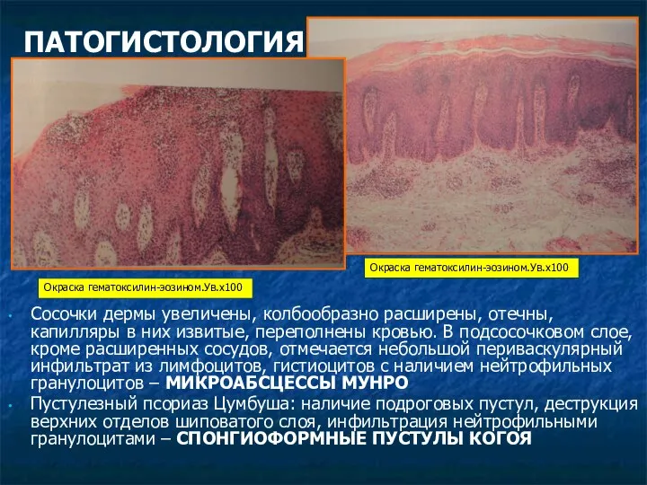 ПАТОГИСТОЛОГИЯ Сосочки дермы увеличены, колбообразно расширены, отечны, капилляры в них извитые,