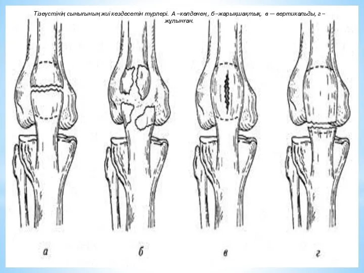 Тізеүстінің сынығының жиі кездесетін түрлері. А –көлденең , б –жарықшақтық, в — вертикальды, г –жұлынған.
