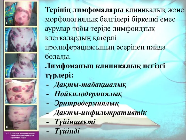 Терінің лимфомалары клиникалық және морфологиялық белгілері біркелкі емес аурулар тобы теріде