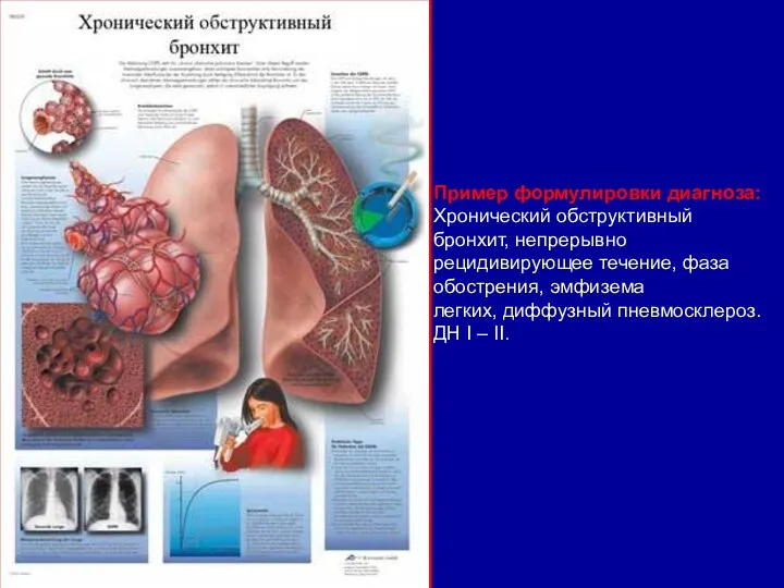 Пример формулировки диагноза: Хронический обструктивный бронхит, непрерывно рецидивирующее течение, фаза обострения,