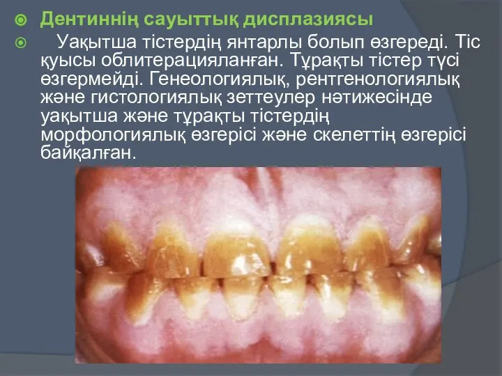 Дентиннің сауыттық дисплазиясы Уақытша тістердің янтарлы болып өзгереді. Тіс қуысы облитерацияланған.