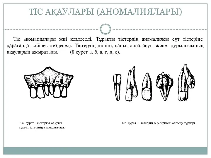 ТIС АҚАУЛАРЫ (АНОМАЛИЯЛАРЫ) Тiс аномалиялары жиi кездеседi. Тұрақты тiстердiң аномалиясы сүт