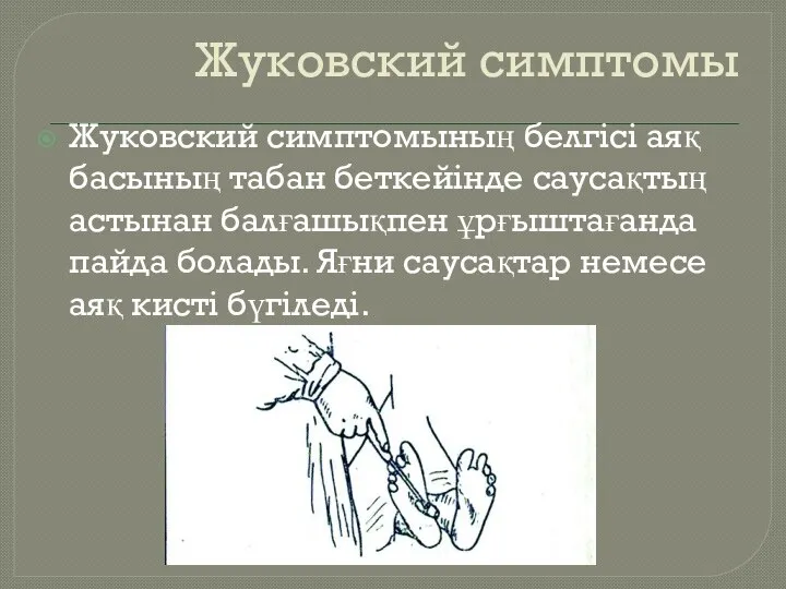 Жуковский симптомы Жуковский симптомының белгісі аяқ басының табан беткейінде саусақтың астынан