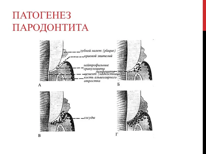 ПАТОГЕНЕЗ ПАРОДОНТИТА