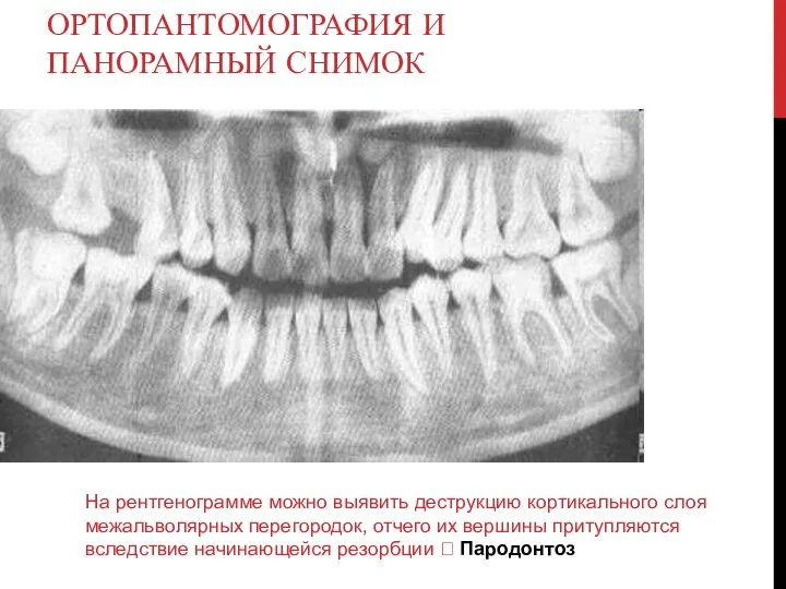 ОРТОПАНТОМОГРАФИЯ И ПАНОРАМНЫЙ СНИМОК На рентгенограмме можно выявить деструкцию кортикального слоя