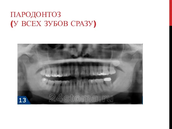 ПАРОДОНТОЗ (У ВСЕХ ЗУБОВ СРАЗУ)