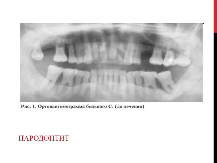 ПАРОДОНТИТ