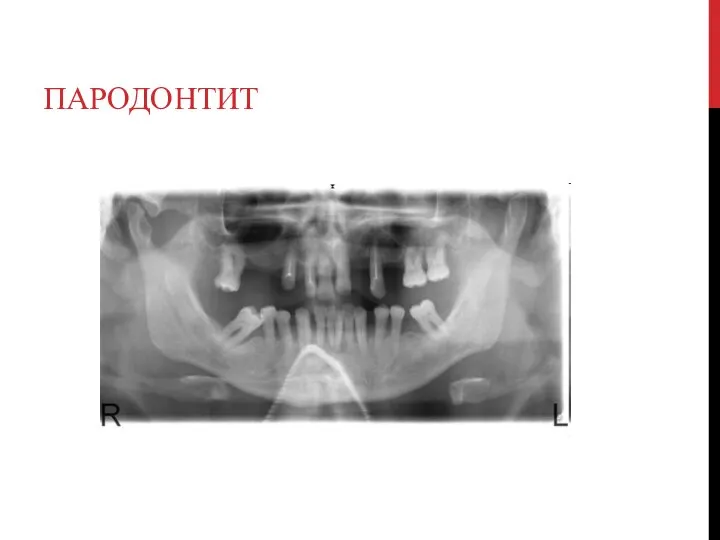 ПАРОДОНТИТ
