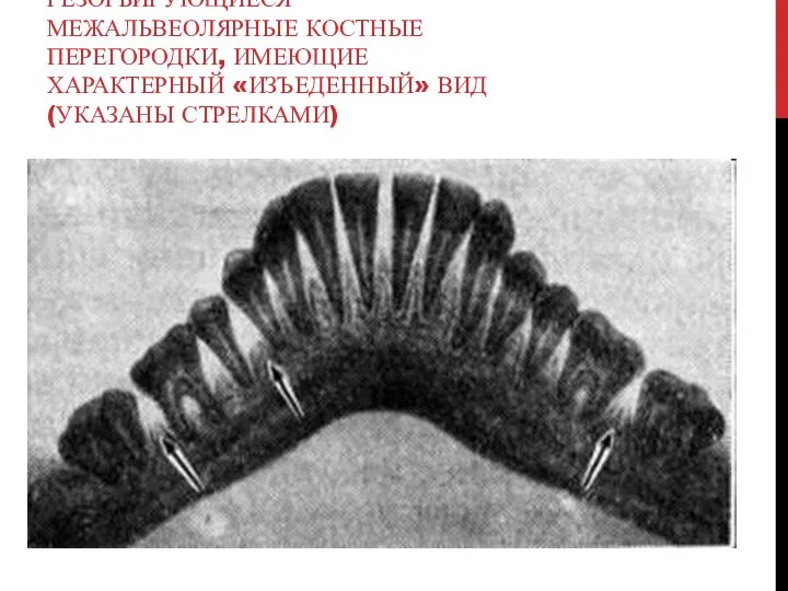 ПАНОРАМНАЯ РЕНТГЕНОГРАММА НИЖНЕЙ ЧЕЛЮСТИ ПРИ ПАРОДОНТОЗЕ: РЕЗОРБИРУЮЩИЕСЯ МЕЖАЛЬВЕОЛЯРНЫЕ КОСТНЫЕ ПЕРЕГОРОДКИ, ИМЕЮЩИЕ ХАРАКТЕРНЫЙ «ИЗЪЕДЕННЫЙ» ВИД (УКАЗАНЫ СТРЕЛКАМИ)