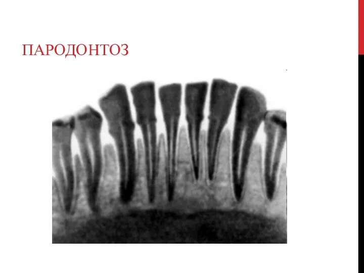 ПАРОДОНТОЗ