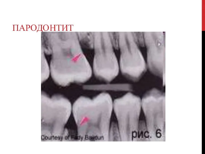 ПАРОДОНТИТ