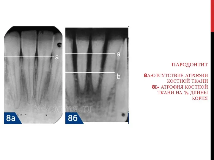 ПАРОДОНТИТ 8А-ОТСУТСТВИЕ АТРОФИИ КОСТНОЙ ТКАНИ 8Б- АТРОФИЯ КОСТНОЙ ТКАНИ НА ½ ДЛИНЫ КОРНЯ